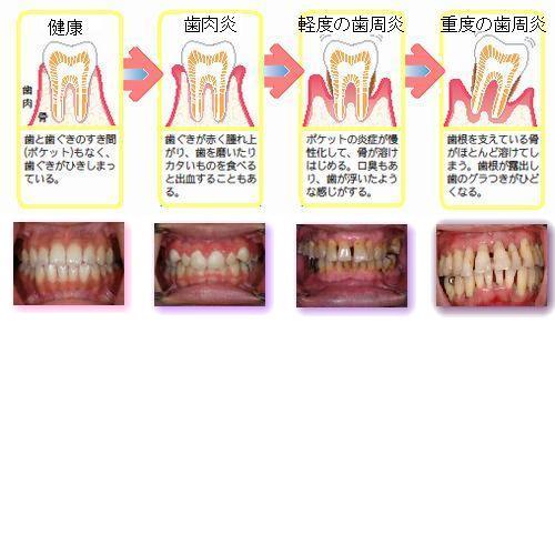 歯周病（説明用画像）.jpg